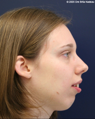 Marie-Hélène Cyr - Profil - Avant des traitements d'orthodontie et des chirurgies orthognatiques (24 novembre 2005)
